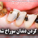 پر کردن دندان سوراخ شده