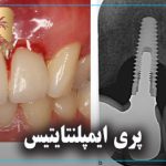پری ایمپلنتایتیس