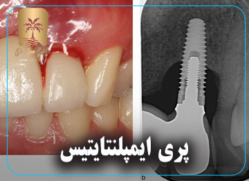 پری ایمپلنتایتیس