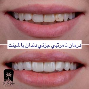 لمینت دندان