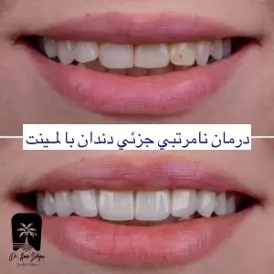 لمینت دندان