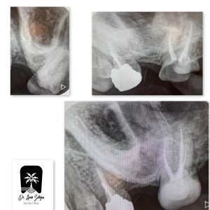 عکس تخلیه آبسه دندان