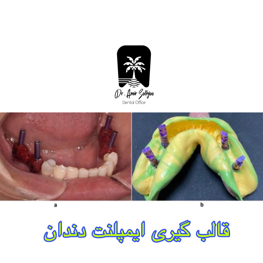 قالبگیری ایمپلنت دندان
