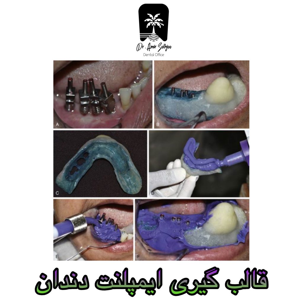 قالبگیری ایمپلنت دندان