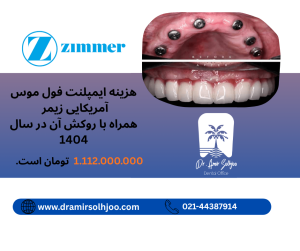 ایمپلنت کامل دندان