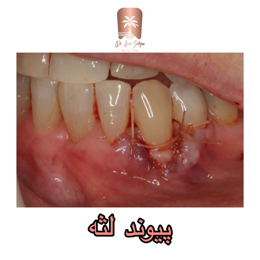 پیوند لثه