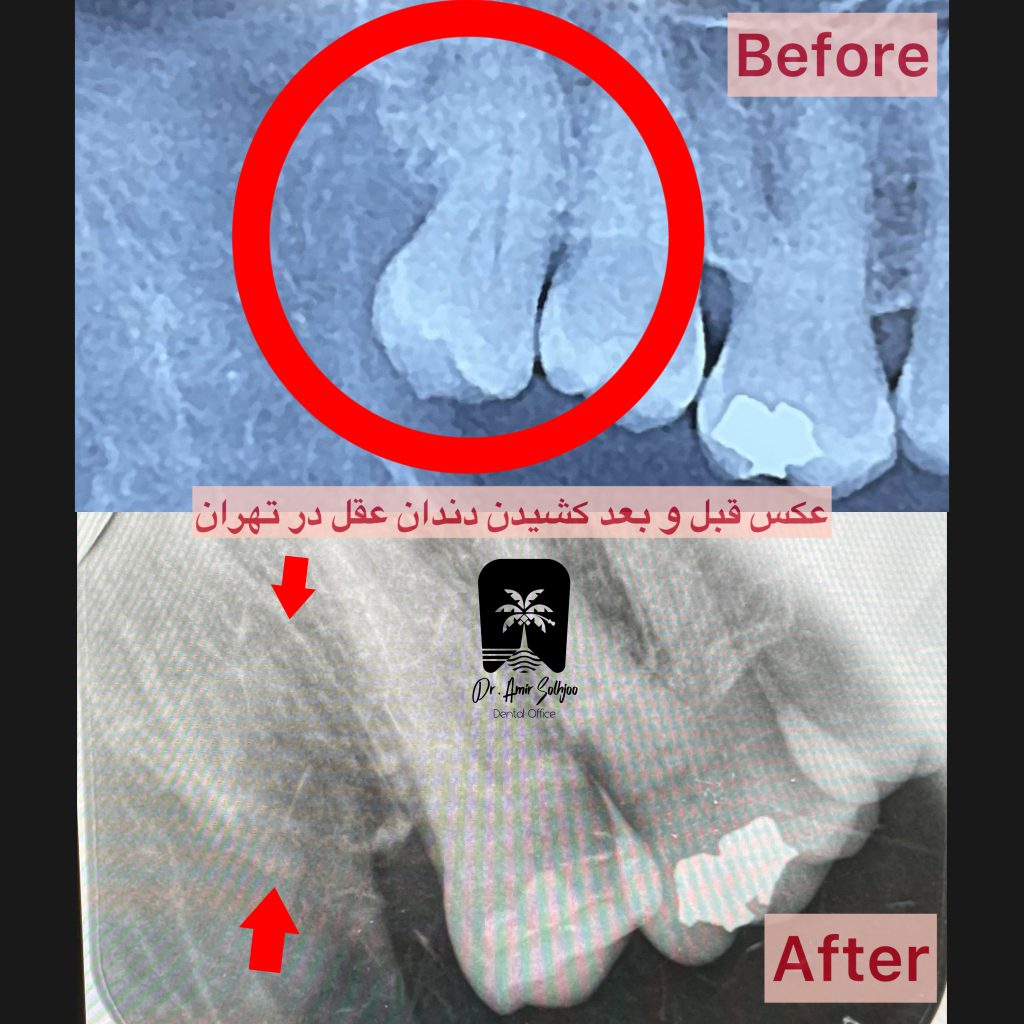 قبل و بعد کشیدن دندان