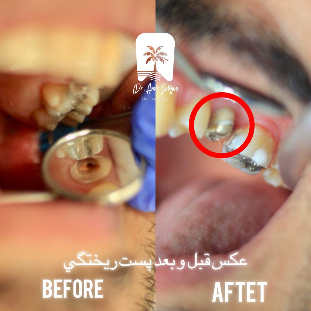 پست ریختگی