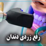 رفع زردی دندان