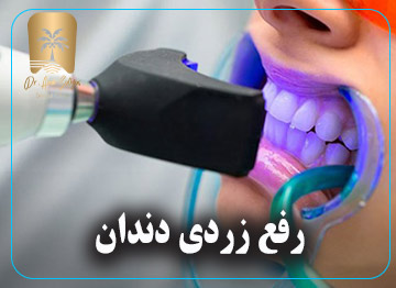 رفع زردی دندان