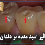تاثیر اسید معده بر دندان
