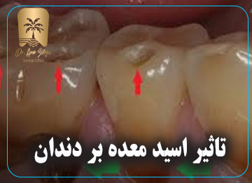 تاثیر اسید معده بر دندان