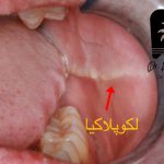 لکوپلاکیا