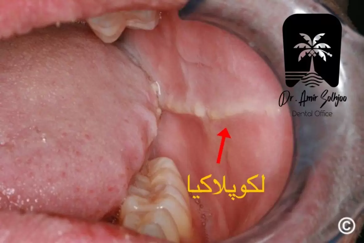لکوپلاکیا