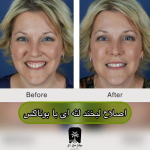 اصلاح لبخند لثه ای