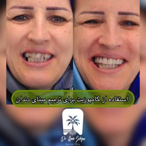 کامپوزیت دندان
