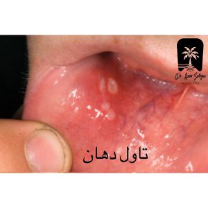 تاول دهان چگونه ایجاد می شود