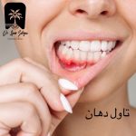 تاول دهان