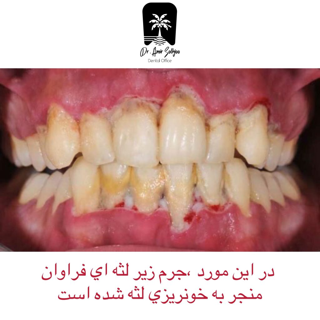 جرم زیر لثه ای