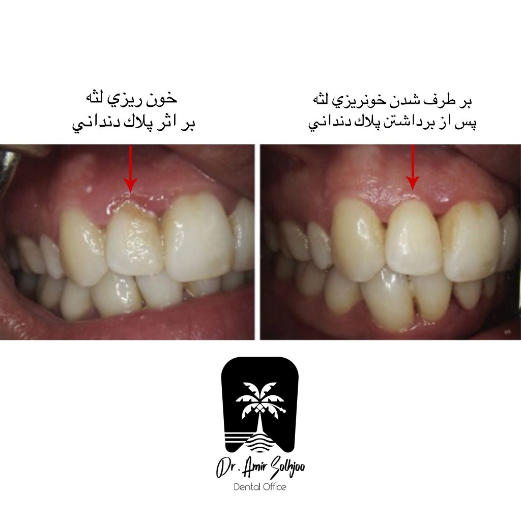 خونریزی لثه