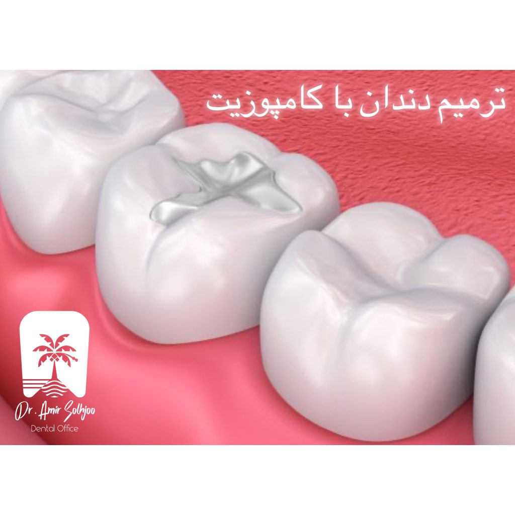 ترمیم دندان با کامپوزیت