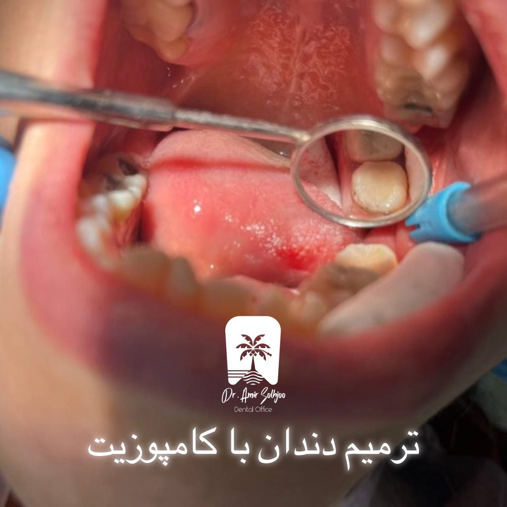 کامپوزیت یا آمالگام
