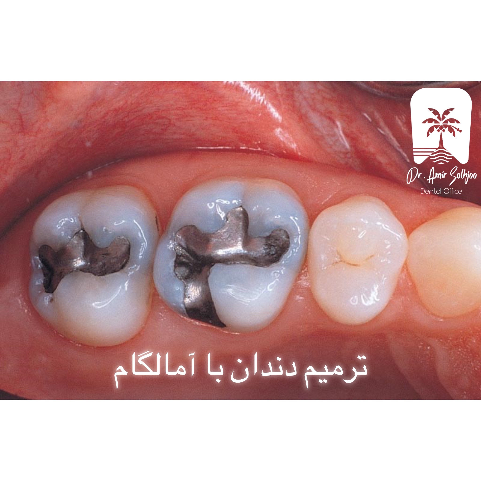 ترمیم دندان با آمالگام