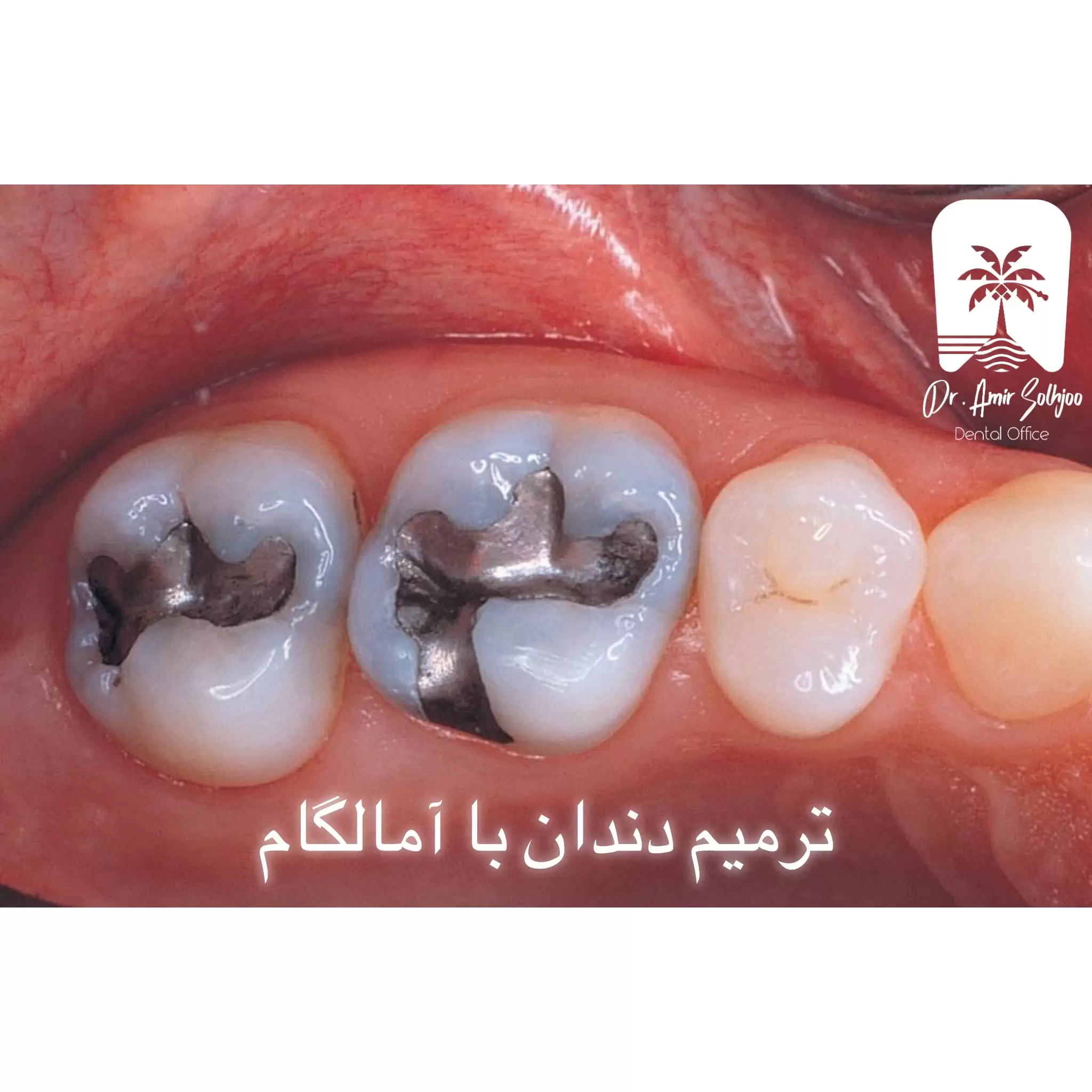 ترمیم دندان با آمالگام