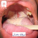 برفک دهان
