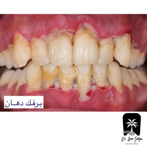 برفک دهان