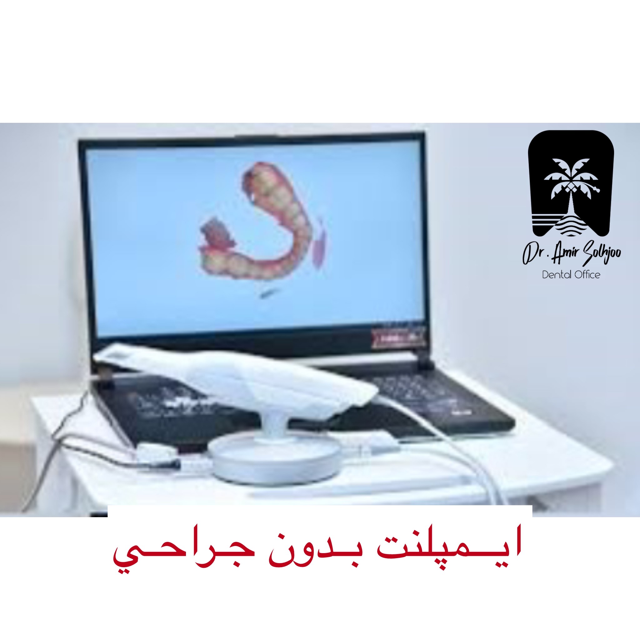 تکنولوژی ایمپلنت بدون جراحی