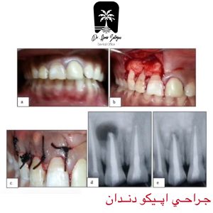 بهترین جراحی اپیکو دندان تهران