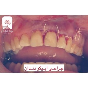 تشخیص و طرح درمان جراحی اپیکو دندان