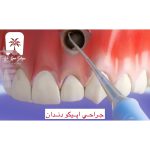 جراحی اپیکو دندان