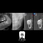 تفاوت عکس cbct و opg