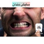 درمان سایش دندان