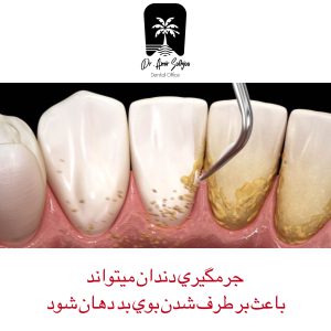 درمان بوی بد دهان
