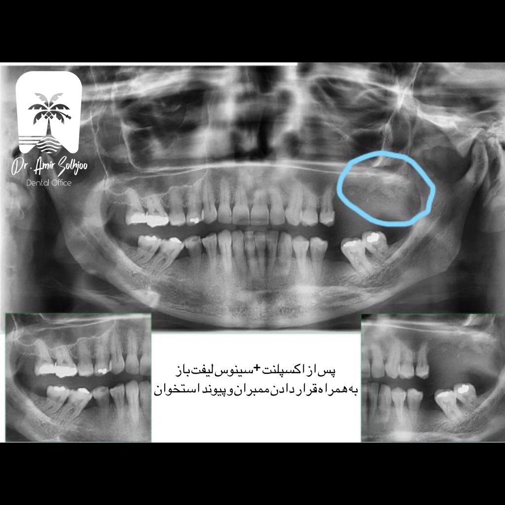 طرح درمان سینوس لیفت