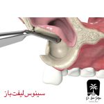 سینوس لیفت اقساطی