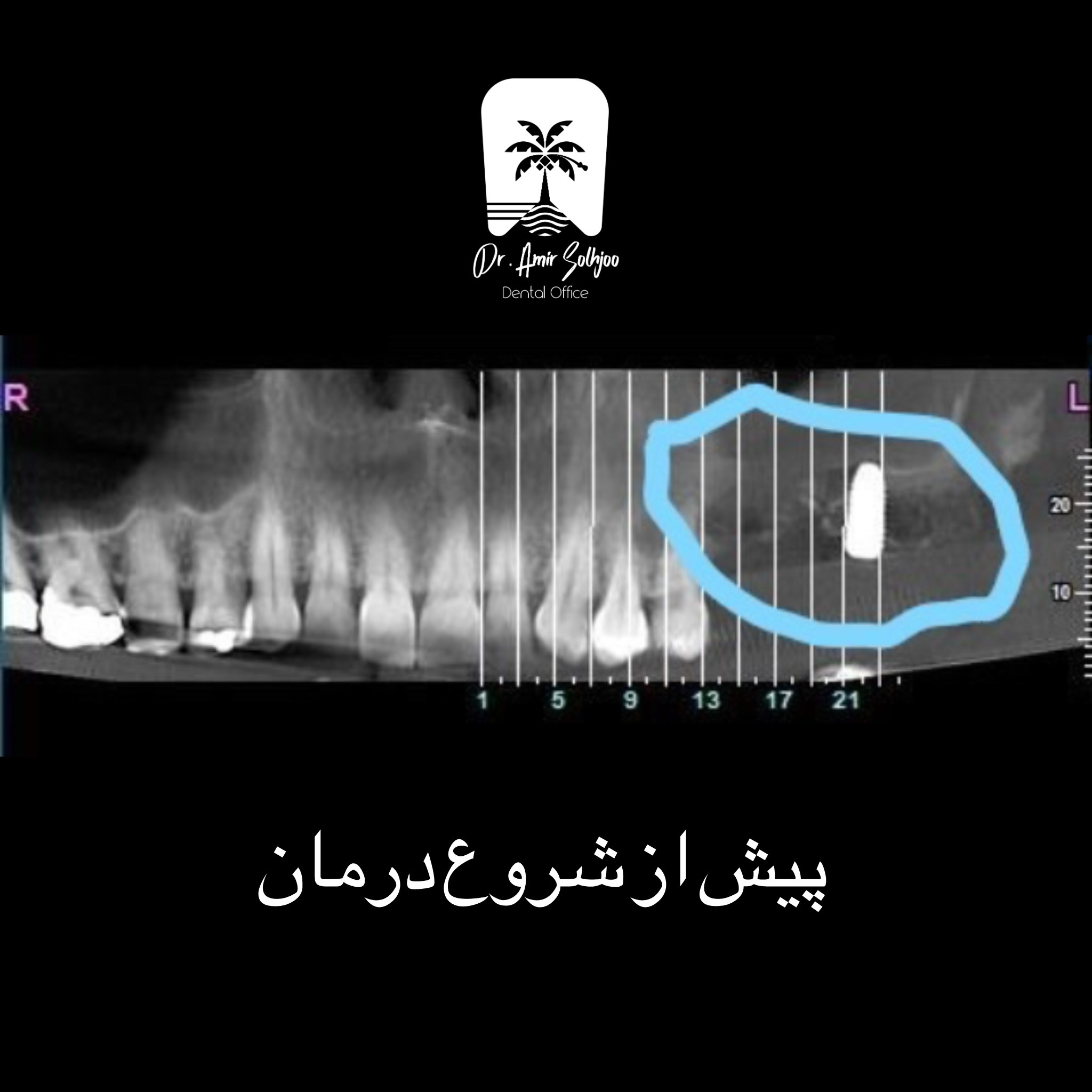 طرح درمان سینوس لیفت