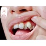 دندان اضافه در لثه