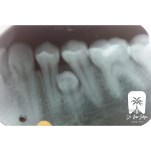 جراحی دندان اضافه در لثه