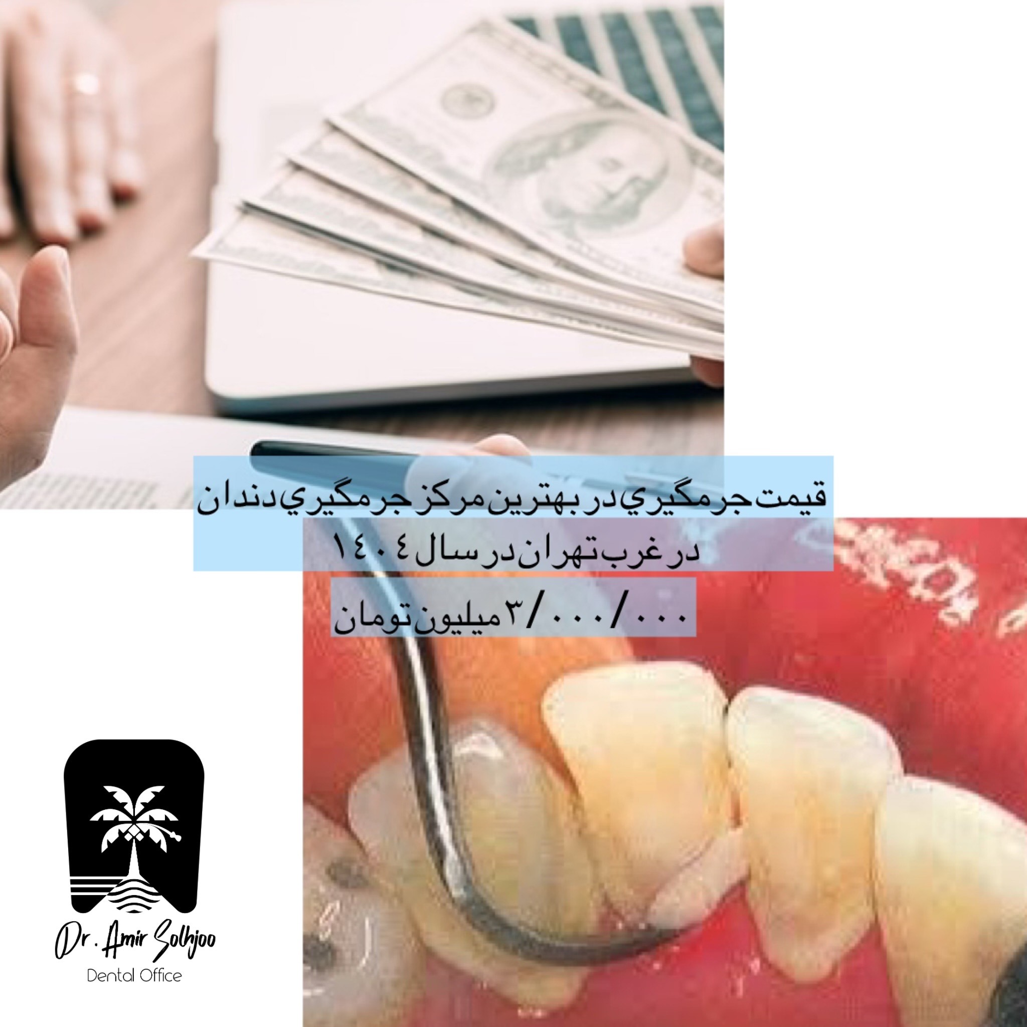 جرم گیری و بروساژ