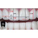 اصلاح طرح لبخند