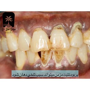 عفونت لثه