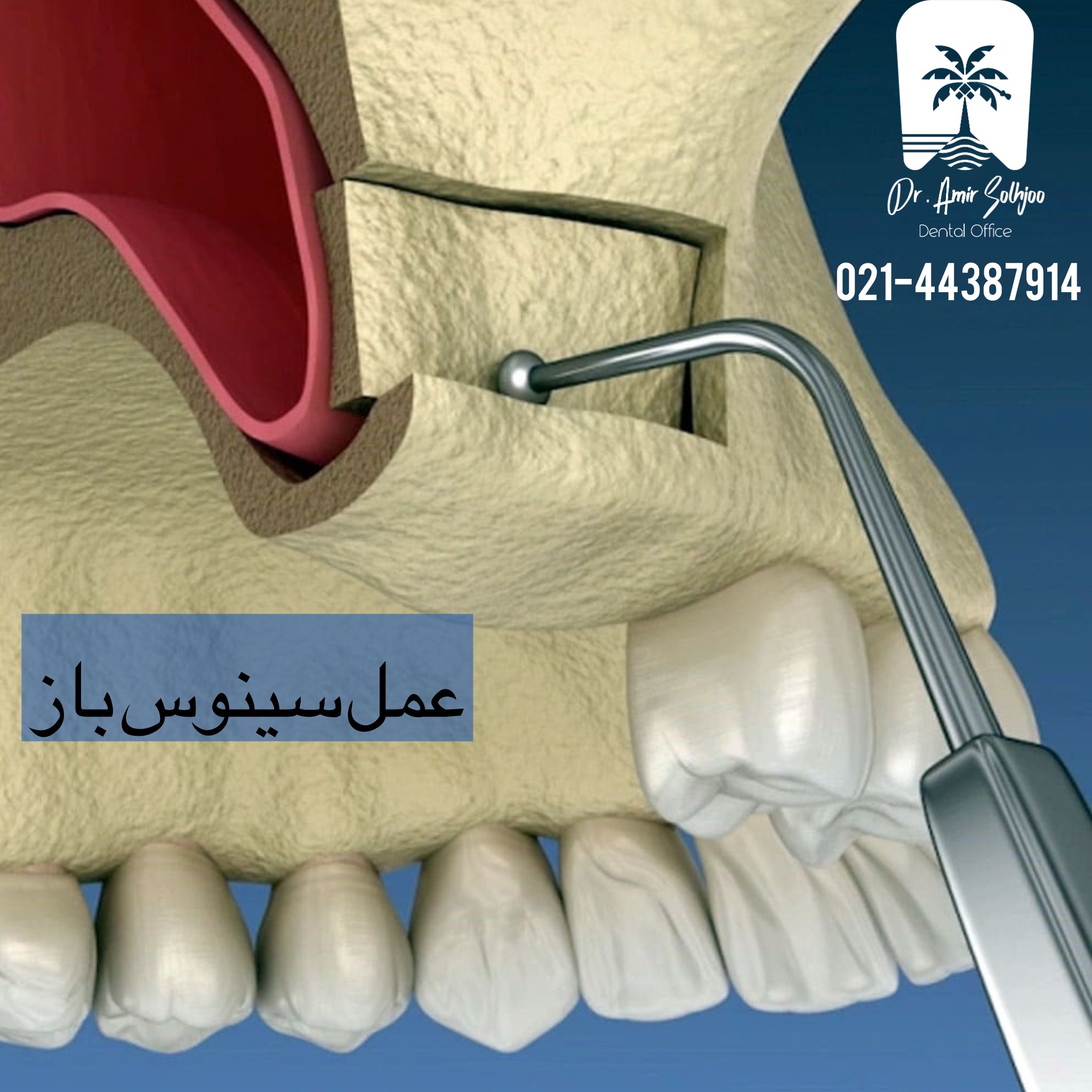 عمل سینوس باز