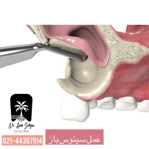 عمل سینوس باز چیست