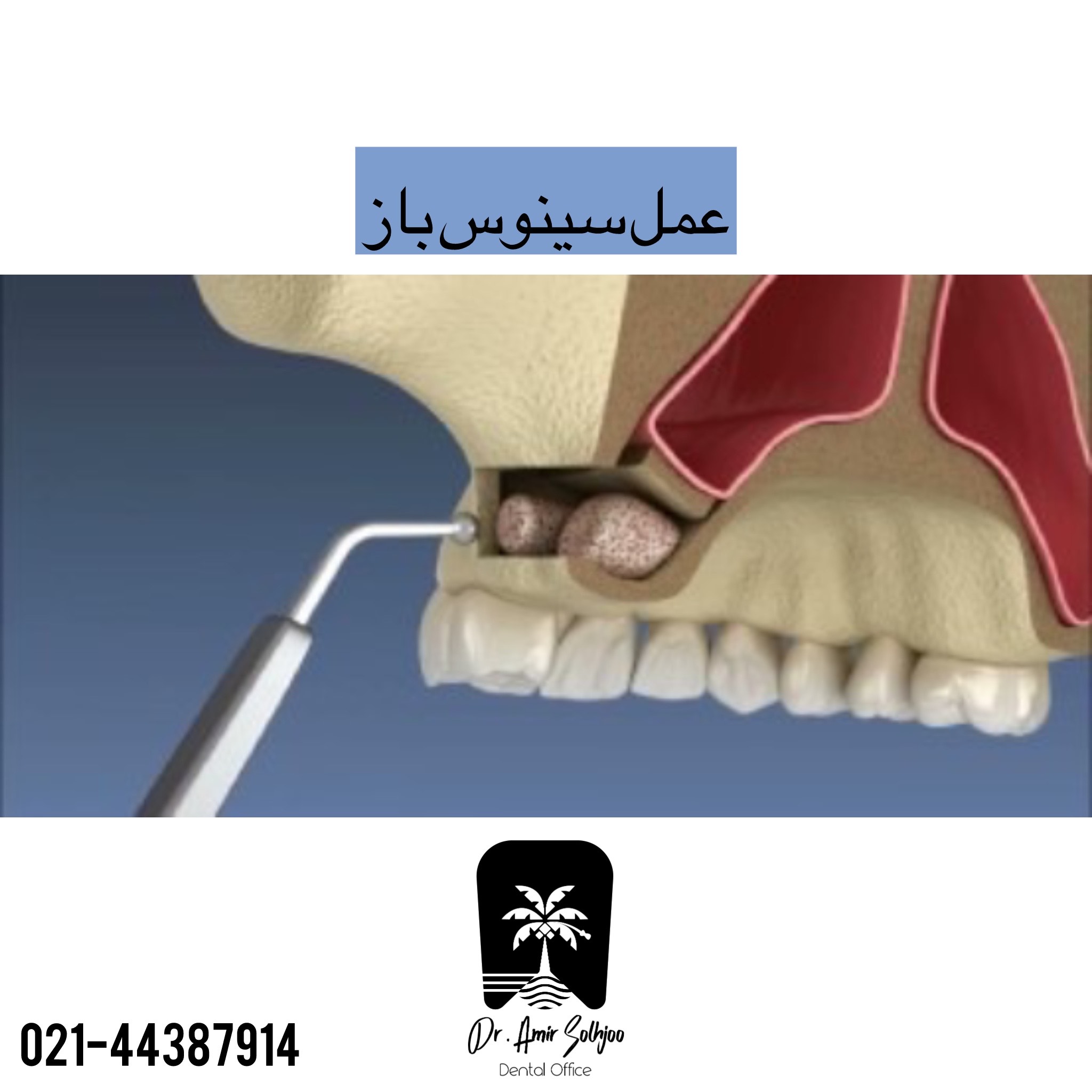جراحی سینوس