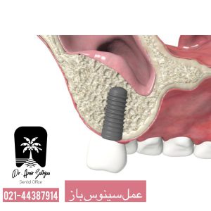سینوس لیفت اقساطی