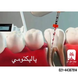 پالپکتومی دندان چیست